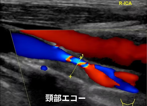 頸動脈エコー