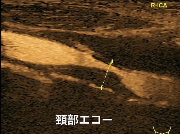 頸動脈エコー