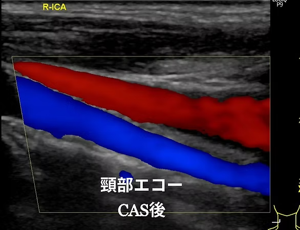 頸動脈エコー