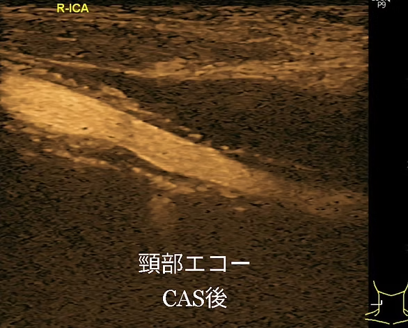 頸動脈エコー