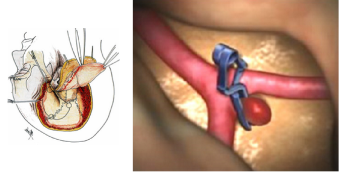 開頭クリッピング手術