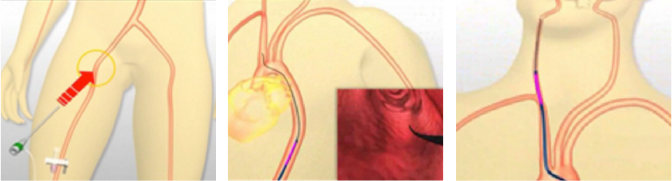 カテーテル手術