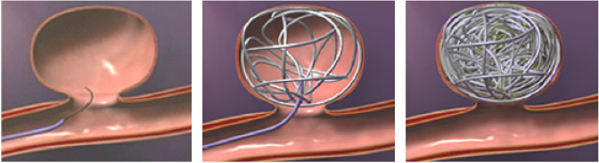 カテーテル手術