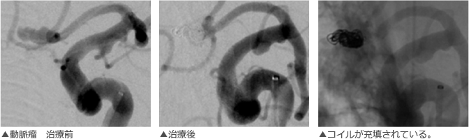 動脈瘤　治療前、治療後、コイルが充填されている様子