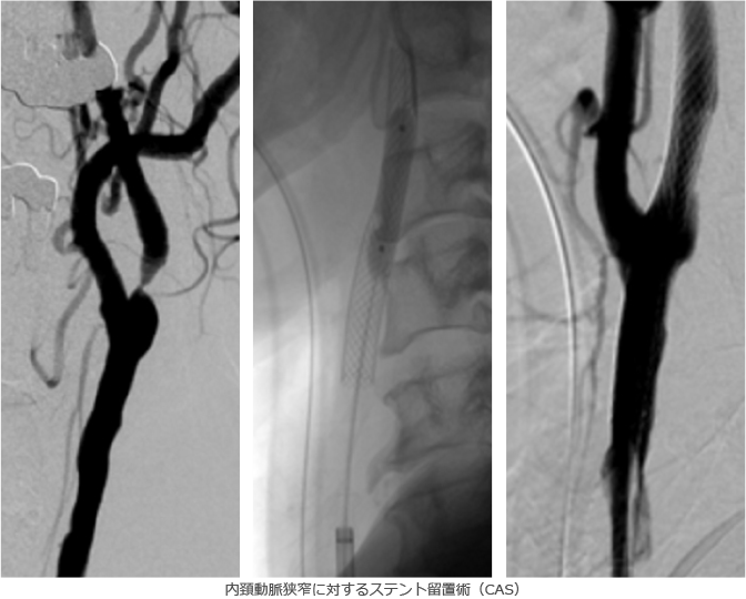 内頸動脈ステント留置術(CAS)