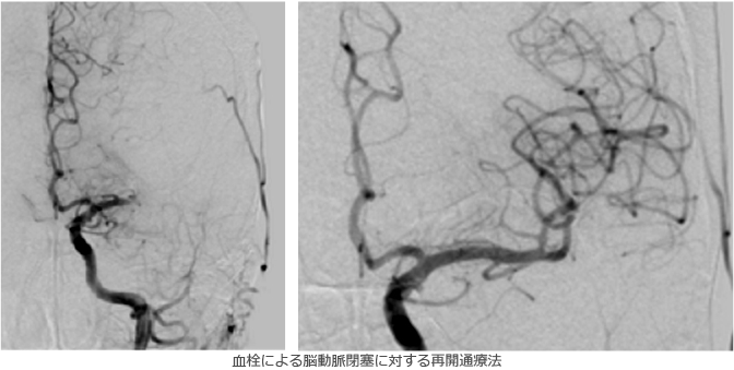 血栓による脳動脈閉塞に対する再開通療法