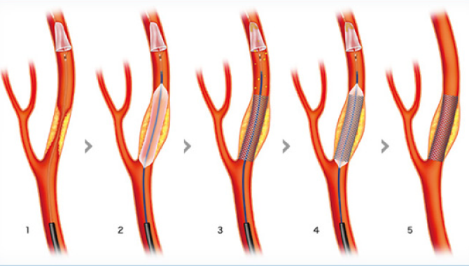 頸動脈狭窄症に対するステント留置術