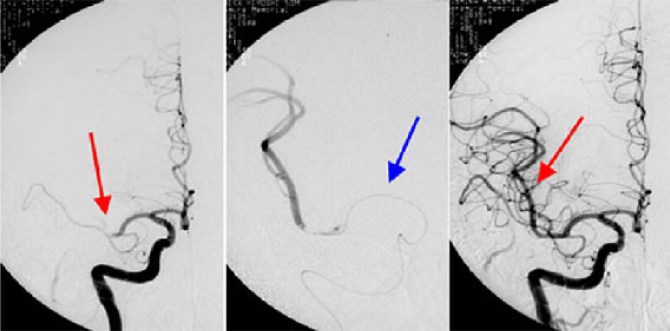 急性期脳梗塞に対する再開通療法