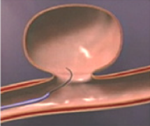 脳動脈瘤に対するコイル塞栓術