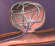 脳動脈瘤に対するコイル塞栓術