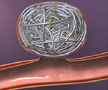 脳動脈瘤に対するコイル塞栓術