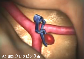 開頭クリッピング術とコイル塞栓術