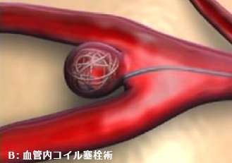 開頭クリッピング術とコイル塞栓術