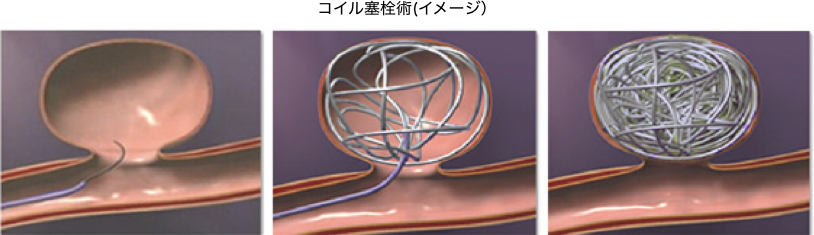 脳血管内治療科