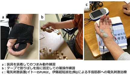 a装具を装着してのつまみ動作練習、bテープで割り箸を指で固定しての箸操作練習、c電気刺激装置(イトーESPURGE、伊藤超短波社(株))による手指筋群への電気刺激治療